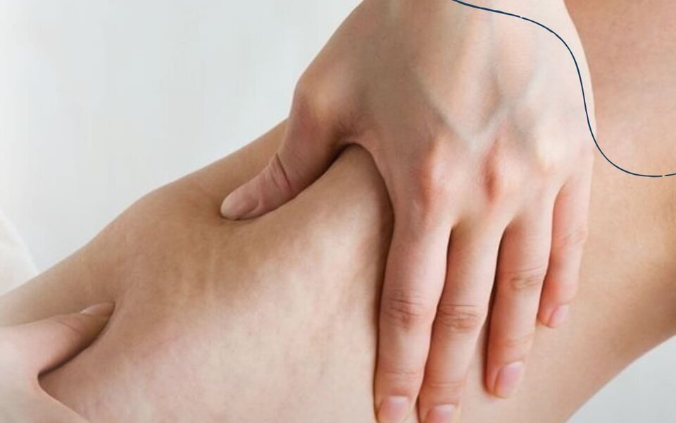 Lipedema: existe idade certa para aparecer?